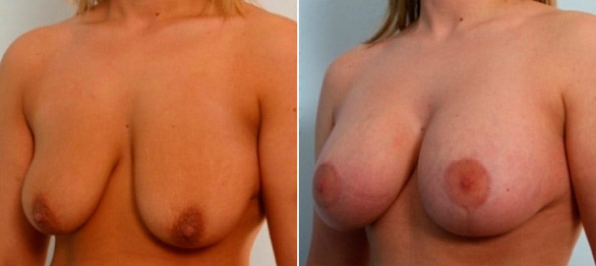 Breast Augmentation-Mastopexy Before & After Gallery - Patient 55021448 - Image 4