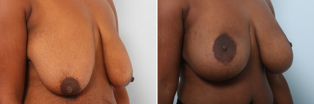 Breast Augmentation-Mastopexy Before & After Photo - Patient 55021449 - Image 2