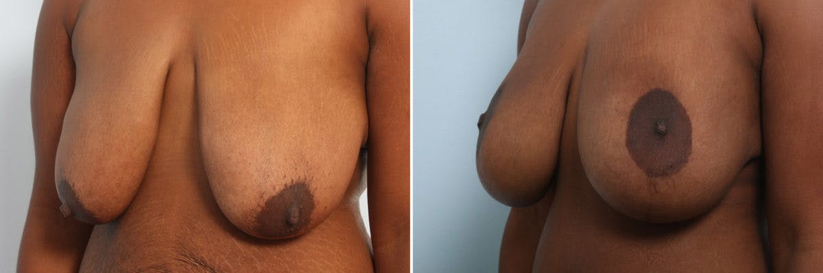 Breast Augmentation-Mastopexy Before & After Photo - Patient 55021449 - Image 4