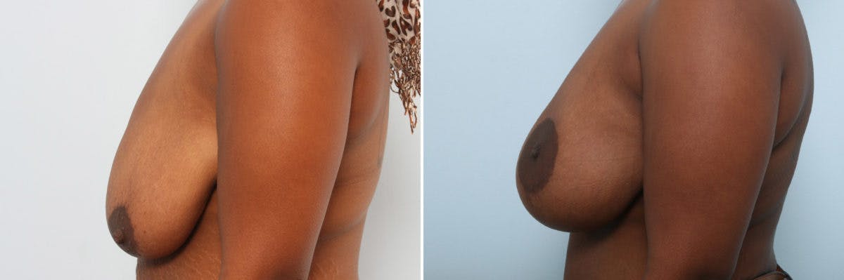 Breast Augmentation-Mastopexy Before & After Photo - Patient 55021449 - Image 5