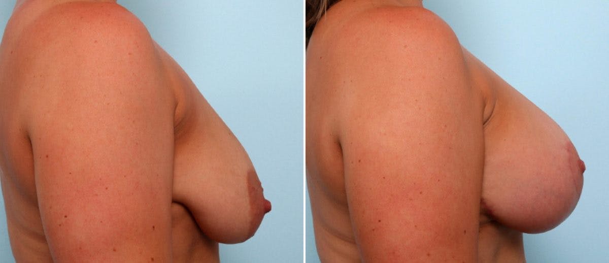 Breast Lift with Augmentation Before & After Gallery - Patient 55484995 - Image 3