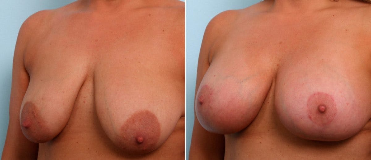 Breast Lift with Augmentation Before & After Gallery - Patient 55484995 - Image 4