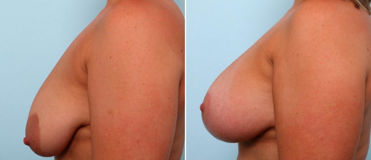 Breast Lift with Augmentation Before & After Gallery - Patient 55484995 - Image 5