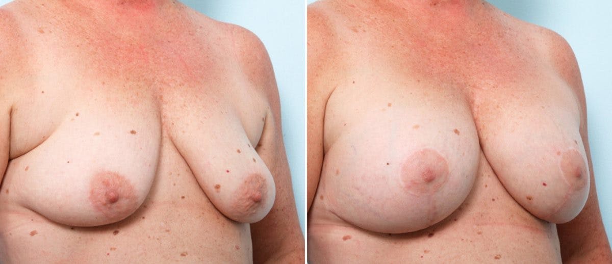Breast Lift with Augmentation Before & After Gallery - Patient 55484996 - Image 2