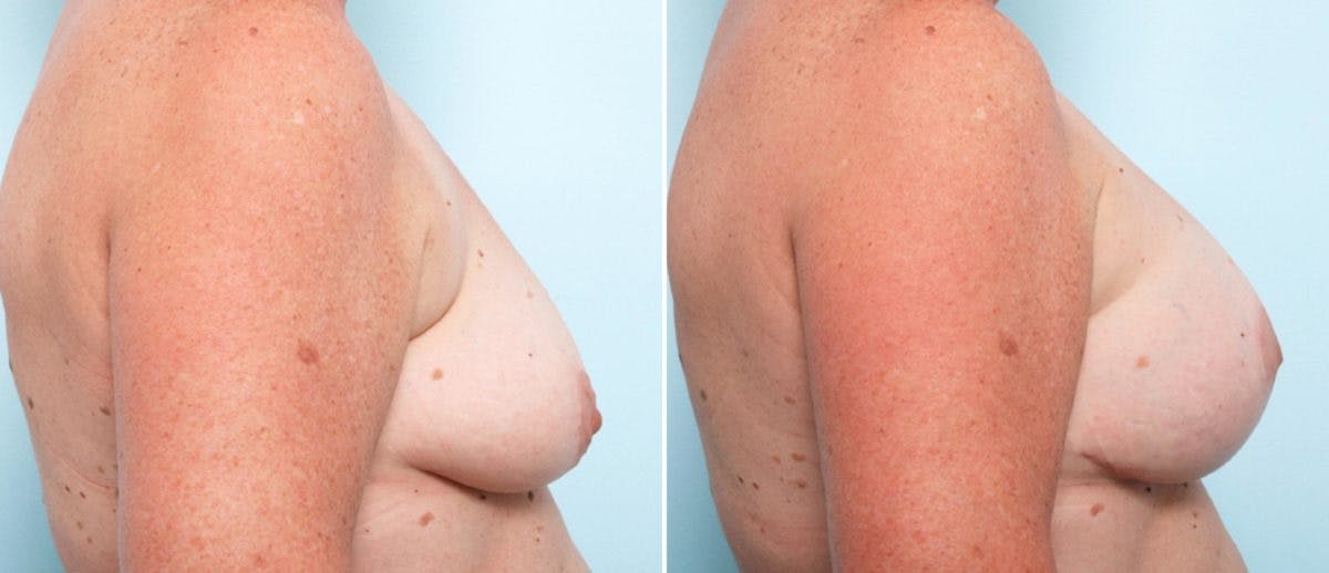 Breast Lift with Augmentation Before & After Gallery - Patient 55484996 - Image 3