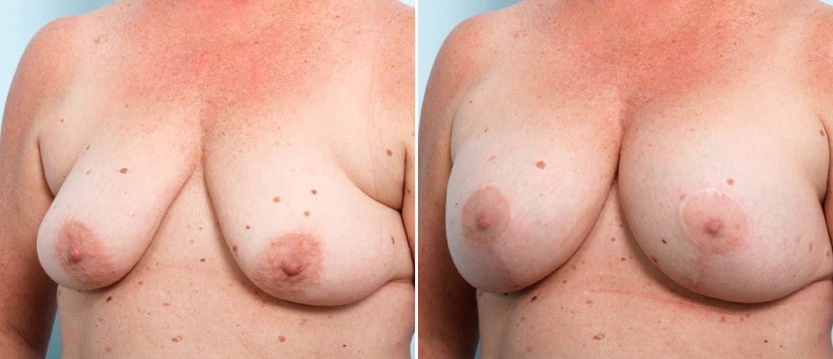 Breast Lift with Augmentation Before & After Gallery - Patient 55484996 - Image 4