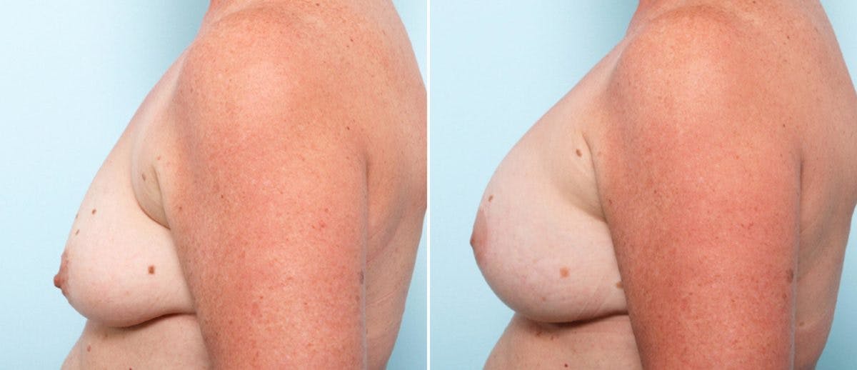 Breast Lift with Augmentation Before & After Gallery - Patient 55484996 - Image 5