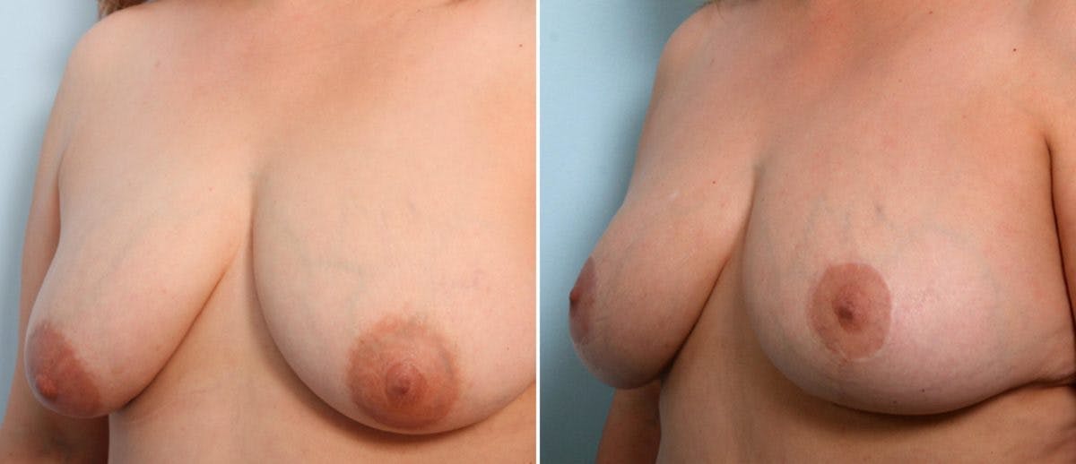 Breast Lift Before & After Gallery - Patient 55078824 - Image 4
