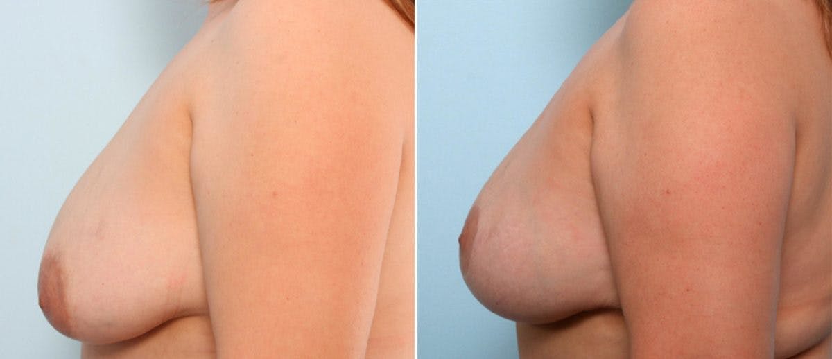 Breast Lift Before & After Gallery - Patient 55078824 - Image 5