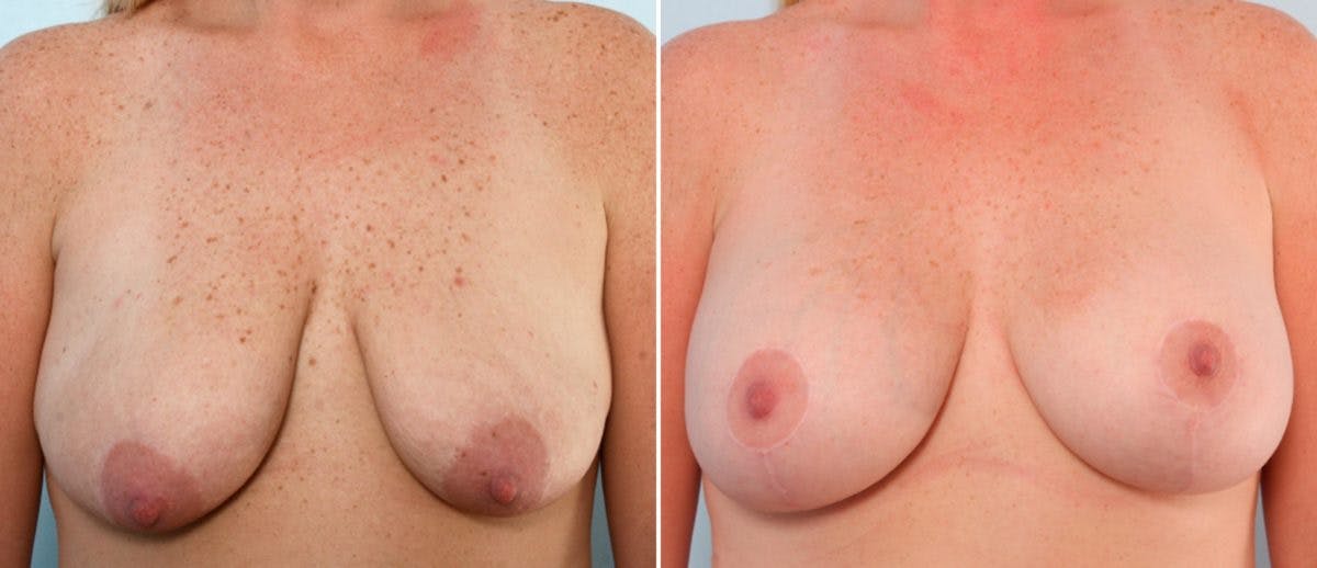 Breast Lift with Augmentation Before & After Gallery - Patient 55484998 - Image 1