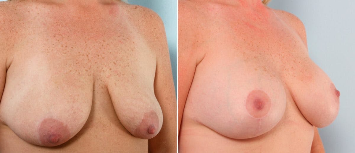 Breast Lift with Augmentation Before & After Gallery - Patient 55484998 - Image 2