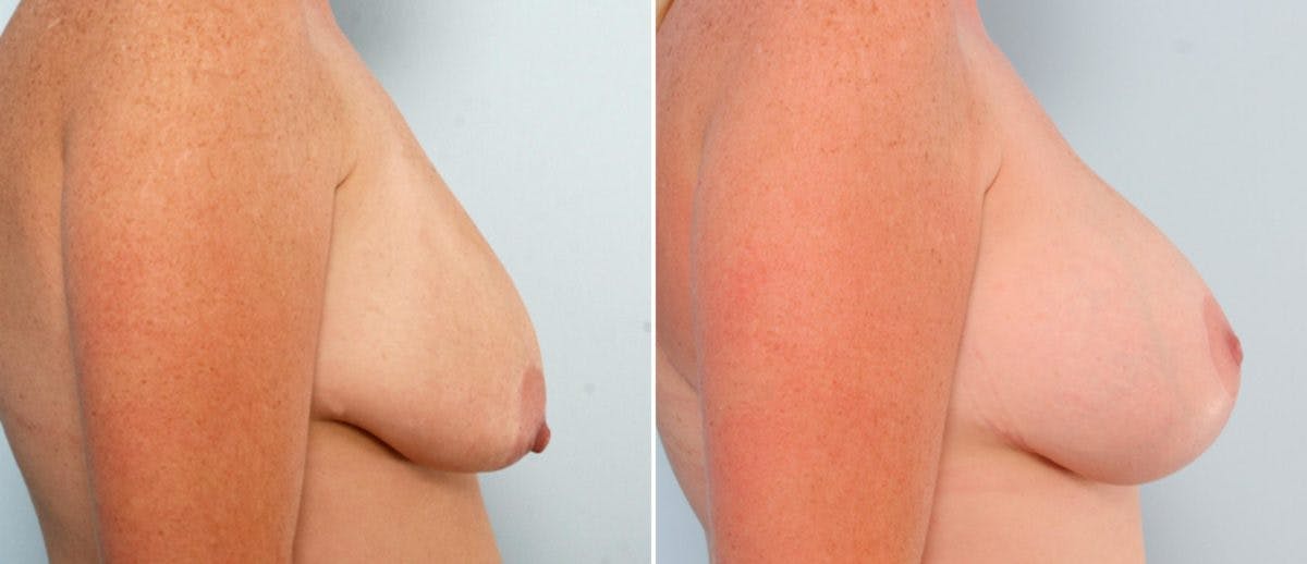 Breast Lift with Augmentation Before & After Gallery - Patient 55484998 - Image 3