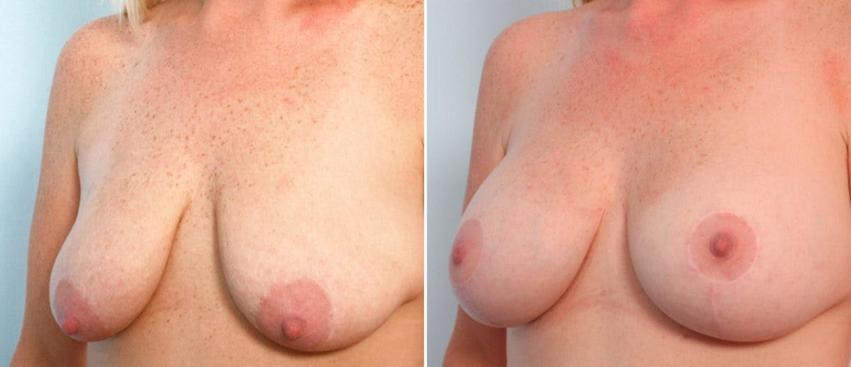 Breast Lift with Augmentation Before & After Gallery - Patient 55484998 - Image 4