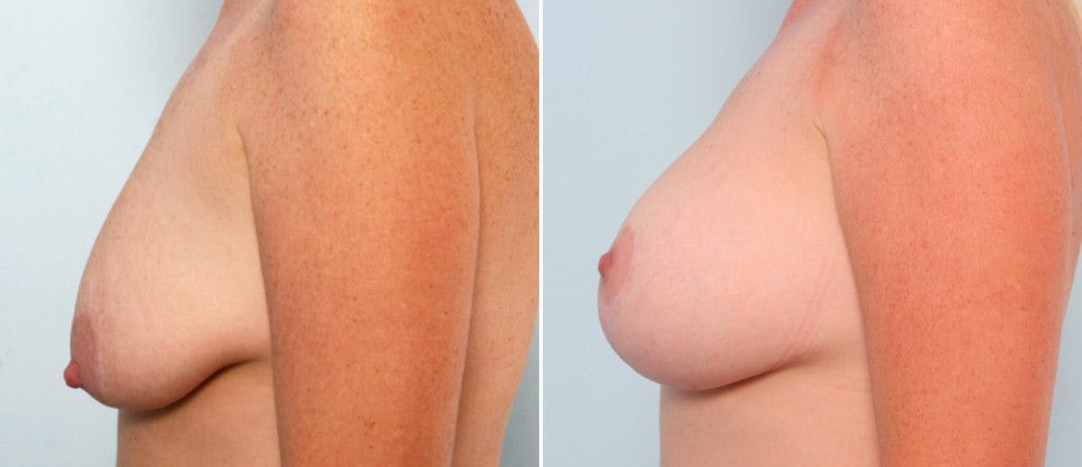 Breast Lift with Augmentation Before & After Gallery - Patient 55484998 - Image 5