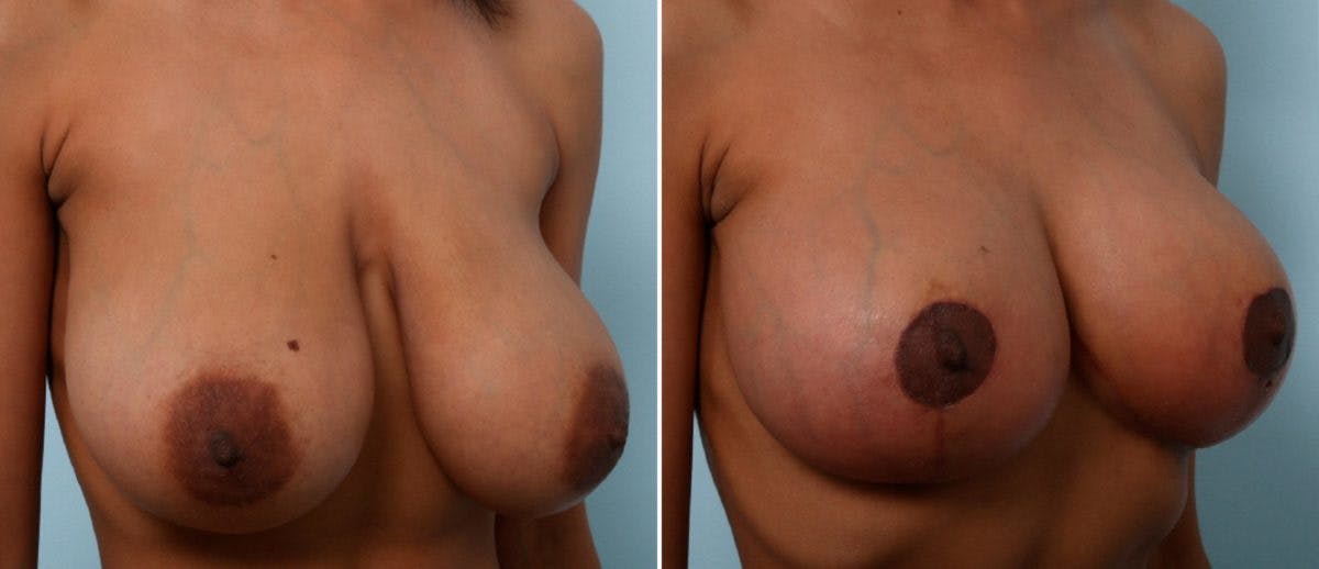 Breast Lift Before & After Gallery - Patient 55078826 - Image 2