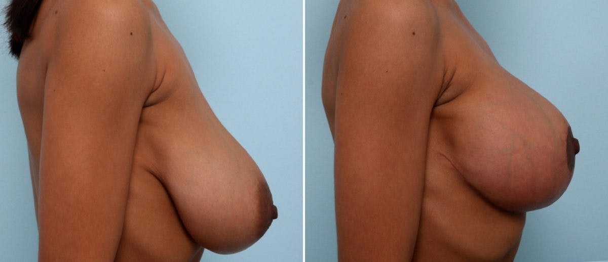 Breast Lift Before & After Gallery - Patient 55078826 - Image 3