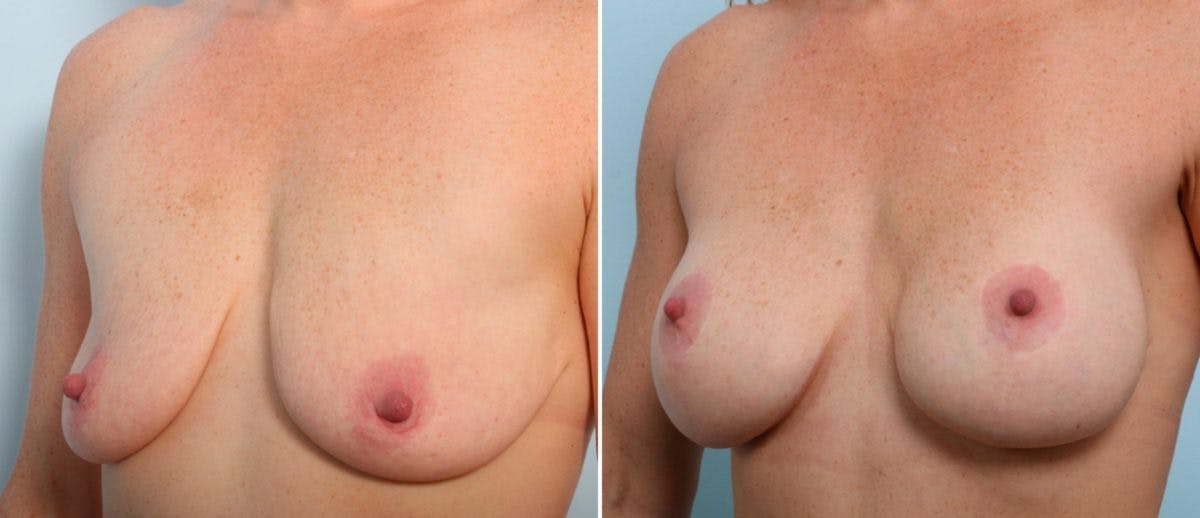Breast Lift with Augmentation Before & After Photo - Patient 55485001 - Image 2