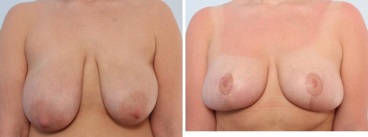 Breast Lift Before & After Gallery - Patient 55078829 - Image 1
