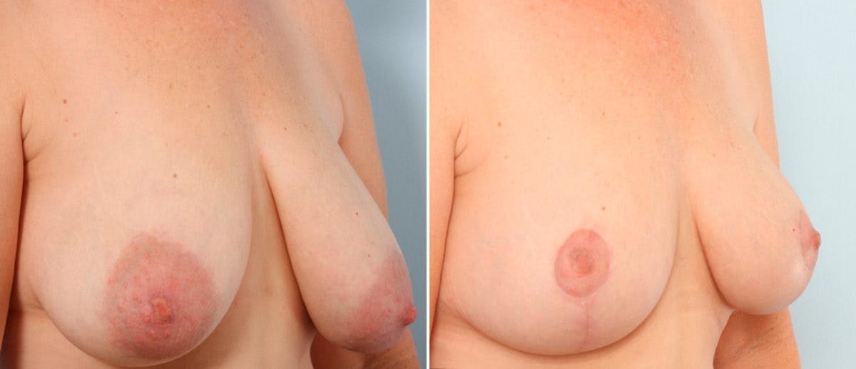 Breast Lift Before & After Photo - Patient 55078833 - Image 2