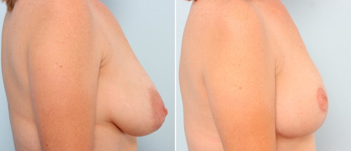 Breast Lift Before & After Gallery - Patient 55078833 - Image 3