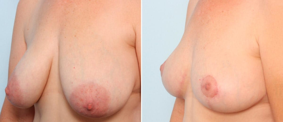 Breast Lift Before & After Photo - Patient 55078833 - Image 4