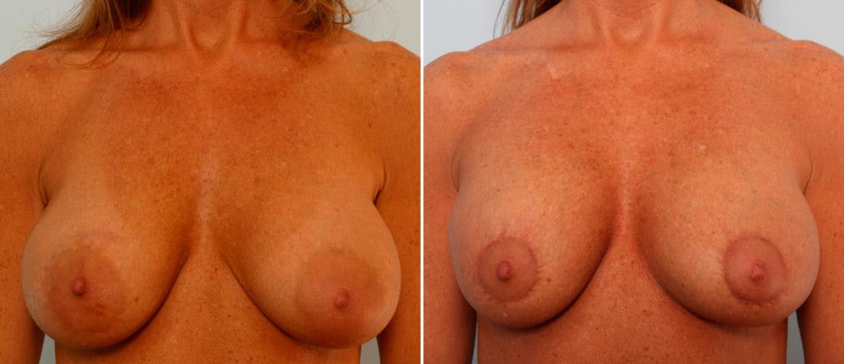 Breast Lift with Augmentation Before & After Photo - Patient 55485004 - Image 1