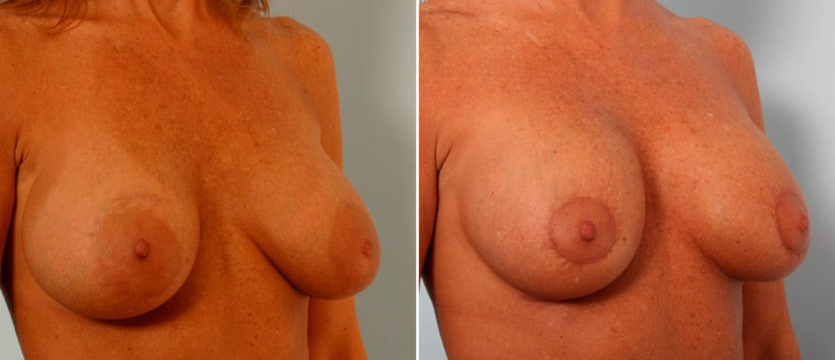 Breast Lift with Augmentation Before & After Photo - Patient 55485004 - Image 2