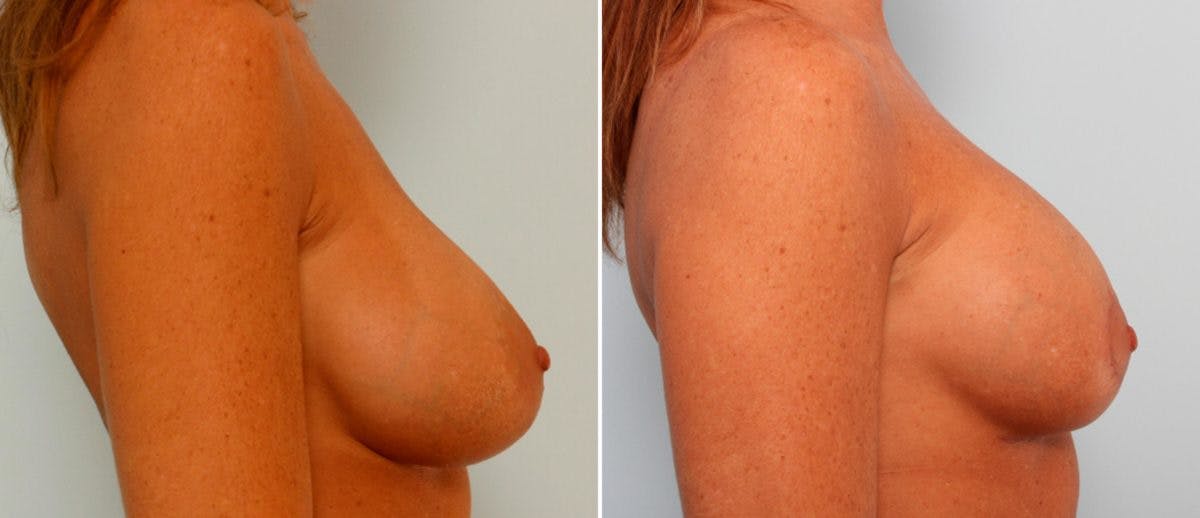 Breast Lift with Augmentation Before & After Gallery - Patient 55485004 - Image 3
