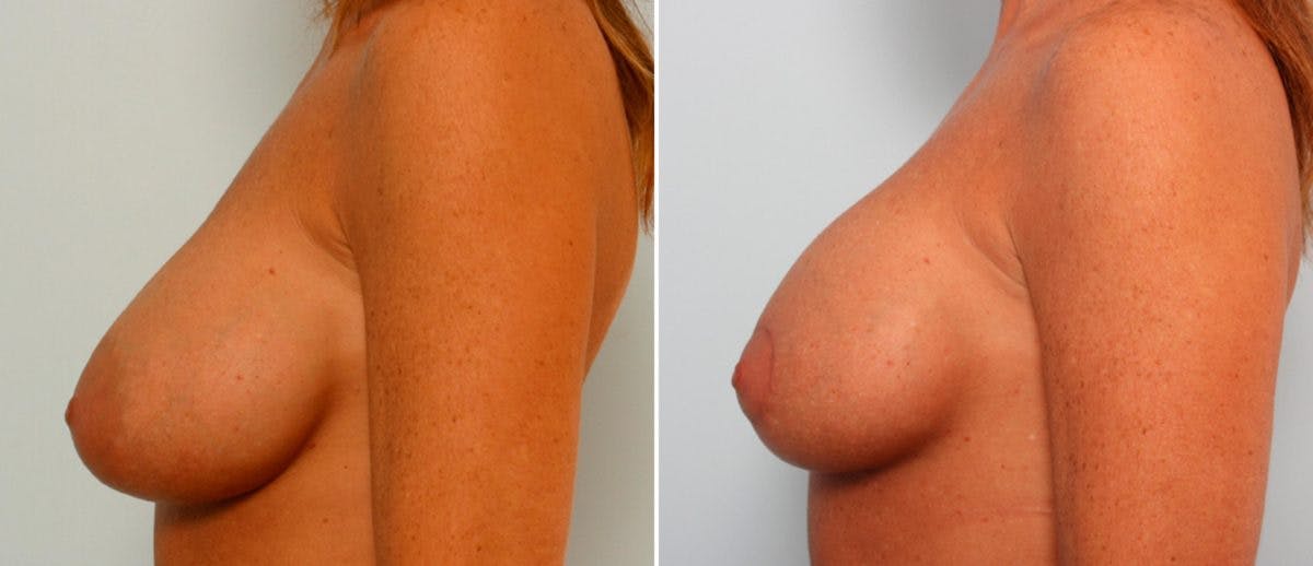 Breast Lift with Augmentation Before & After Photo - Patient 55485004 - Image 5