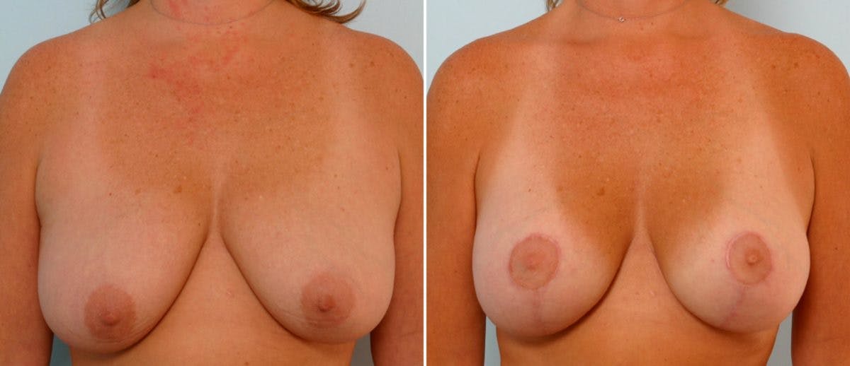 Breast Lift with Augmentation Before & After Gallery - Patient 55485005 - Image 1