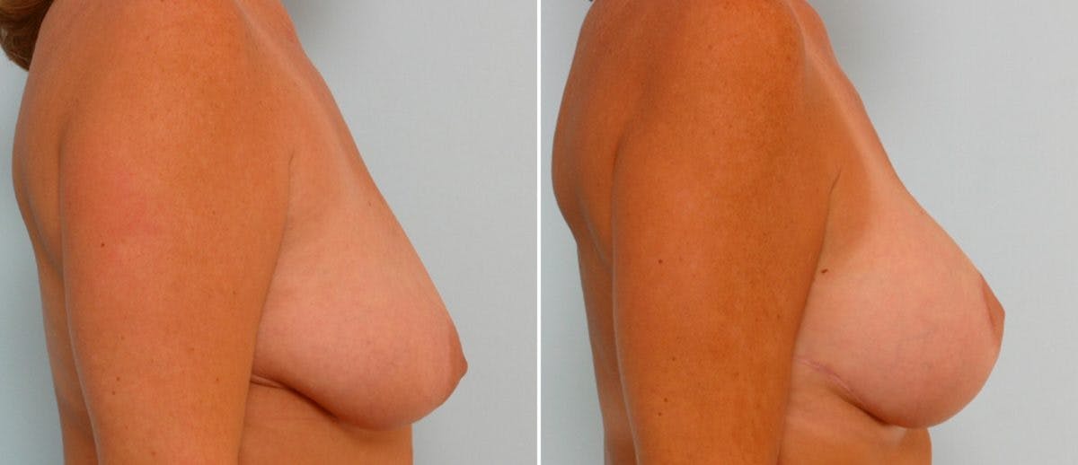Breast Lift with Augmentation Before & After Gallery - Patient 55485005 - Image 3