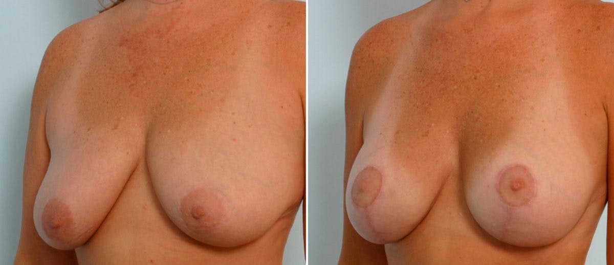 Breast Lift with Augmentation Before & After Gallery - Patient 55485005 - Image 4