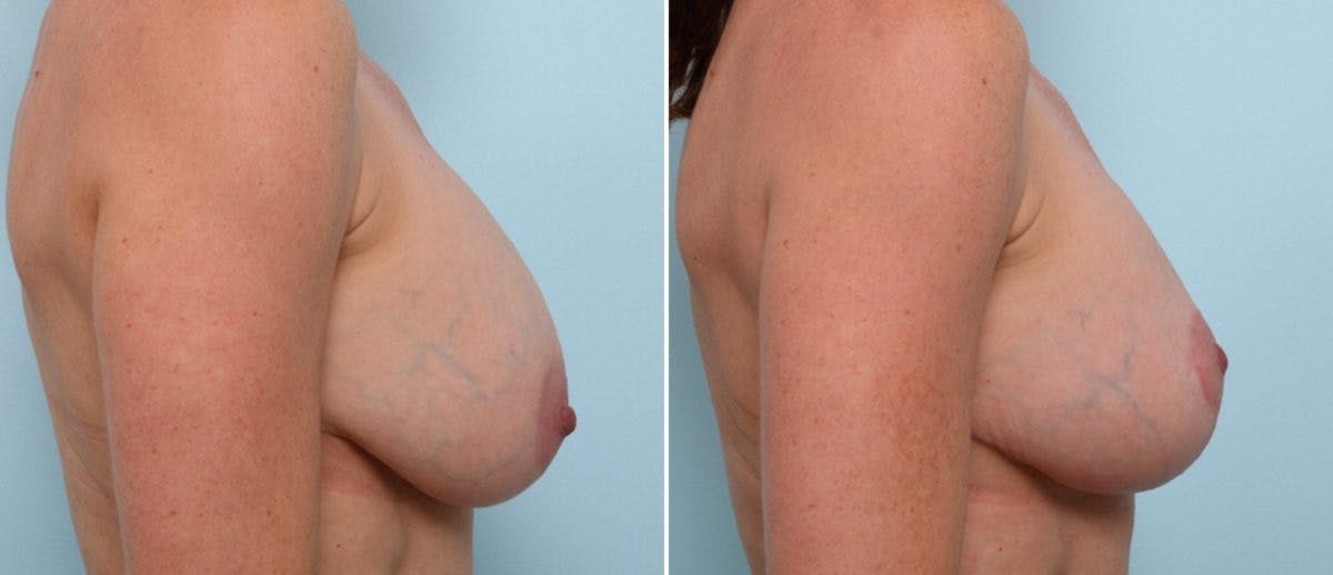 Breast Lift Before & After Photo - Patient 55078839 - Image 3