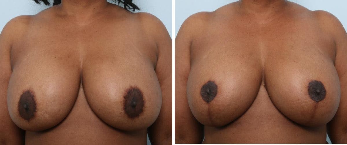 Breast Lift with Augmentation Before & After Gallery - Patient 55485007 - Image 1