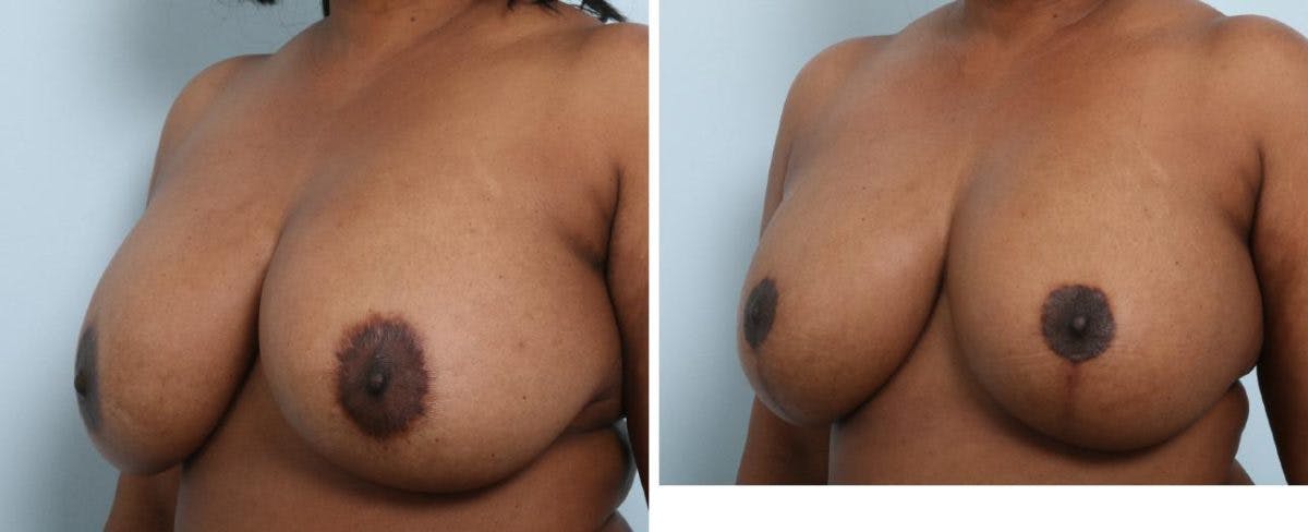 Breast Lift with Augmentation Before & After Gallery - Patient 55485007 - Image 4