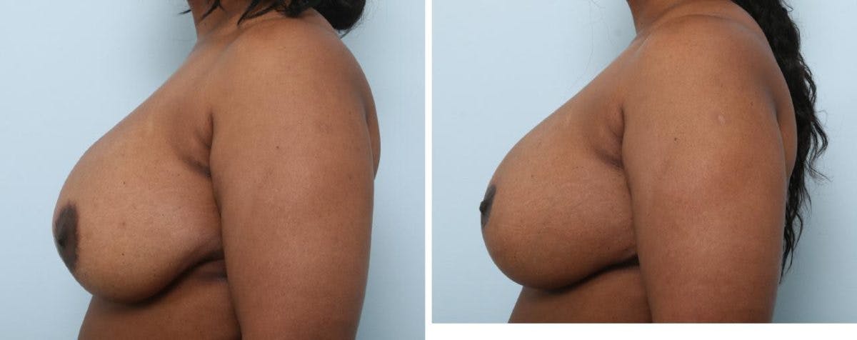 Breast Lift with Augmentation Before & After Gallery - Patient 55485007 - Image 5
