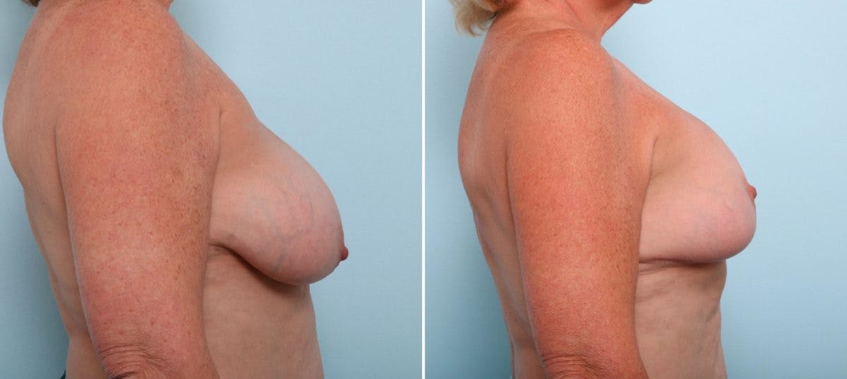 Breast Lift Before & After Gallery - Patient 55078841 - Image 3