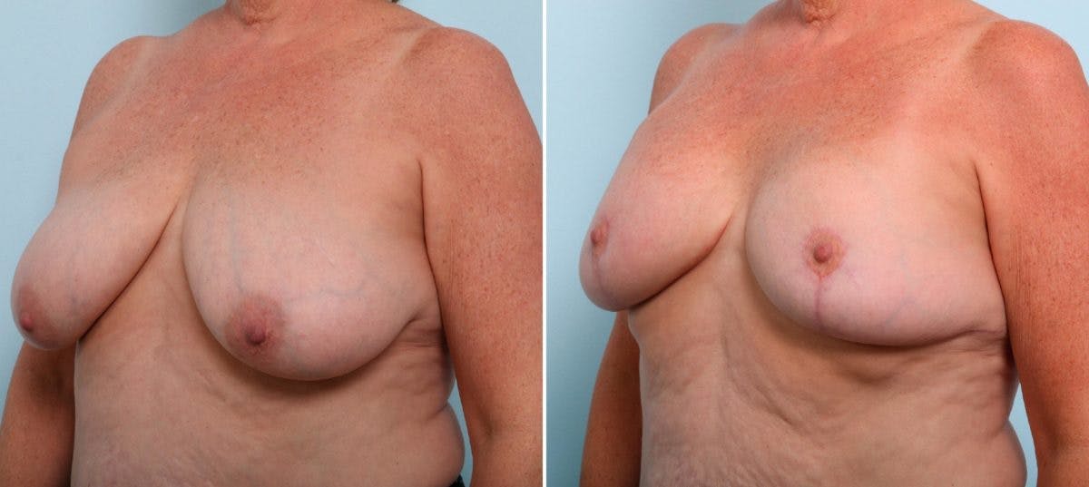 Breast Lift Before & After Gallery - Patient 55078841 - Image 4