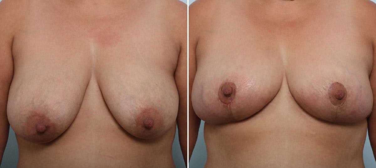 Breast Lift Before & After Gallery - Patient 55078845 - Image 1