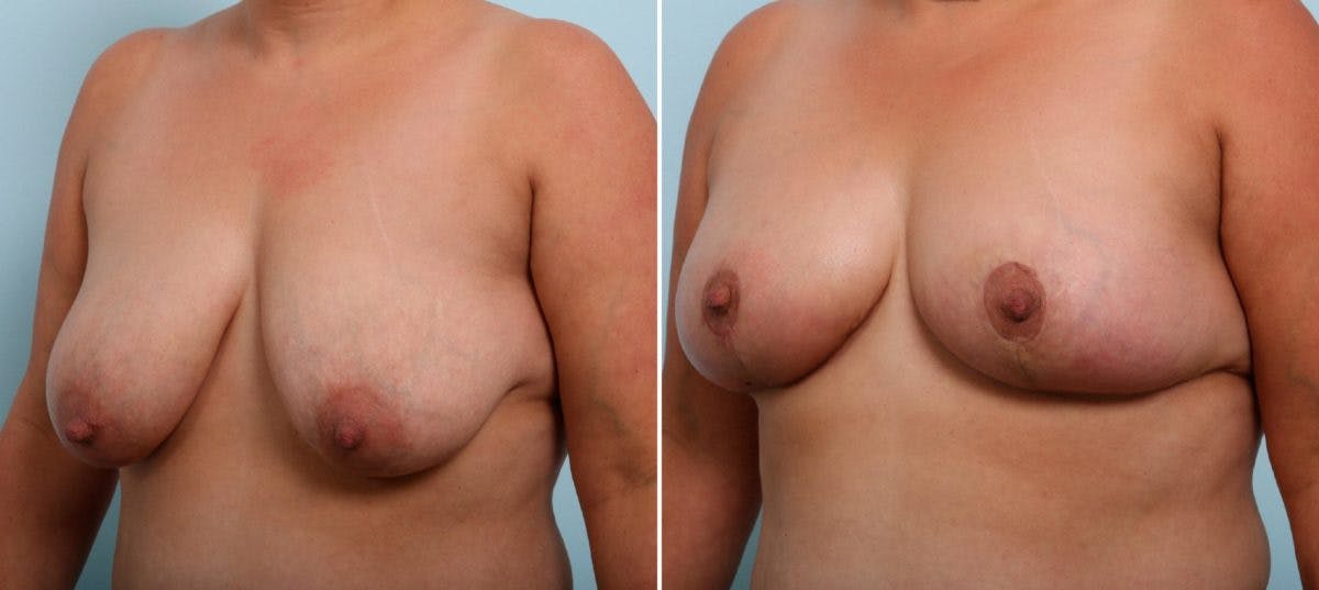 Breast Lift Before & After Gallery - Patient 55078845 - Image 4