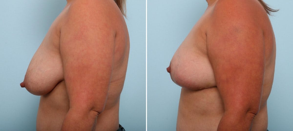 Breast Lift Before & After Gallery - Patient 55078845 - Image 5