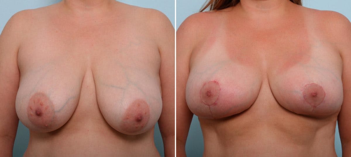 Breast Lift Before & After Gallery - Patient 55078846 - Image 1