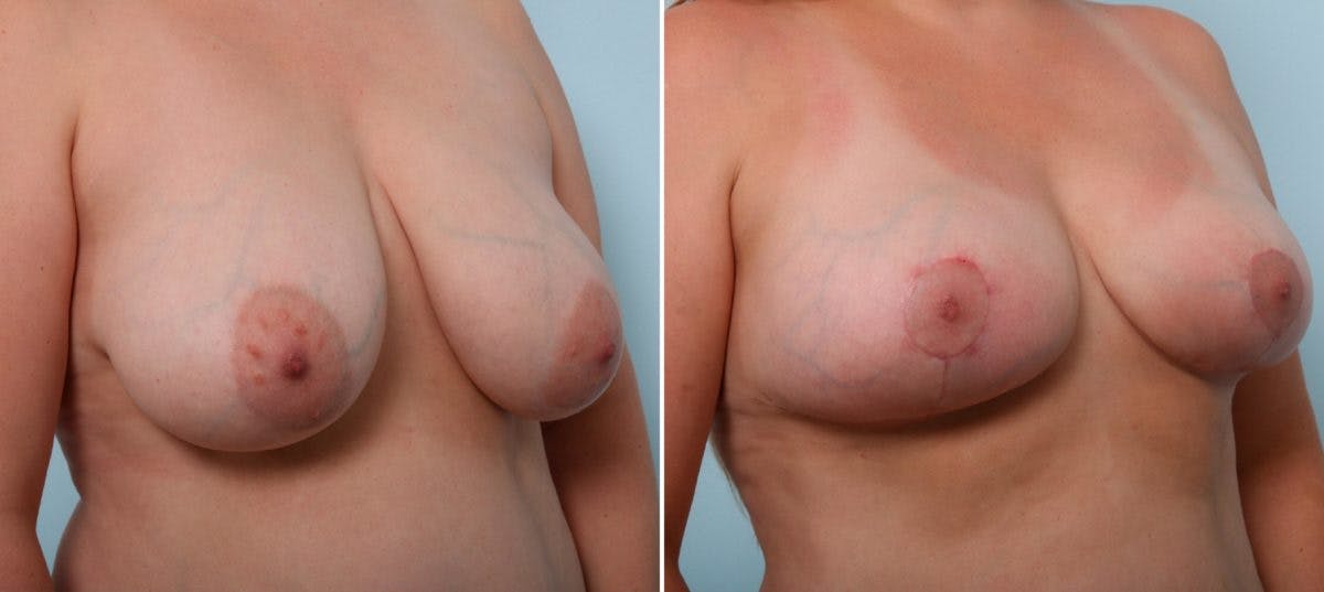 Breast Lift Before & After Gallery - Patient 55078846 - Image 2