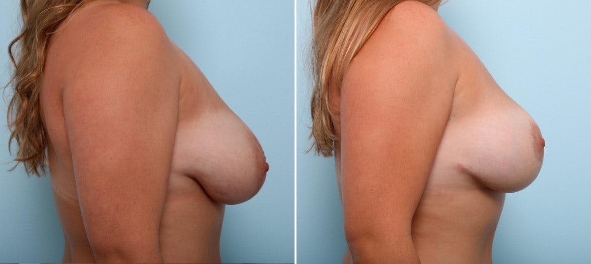 Breast Lift Before & After Gallery - Patient 55078847 - Image 3