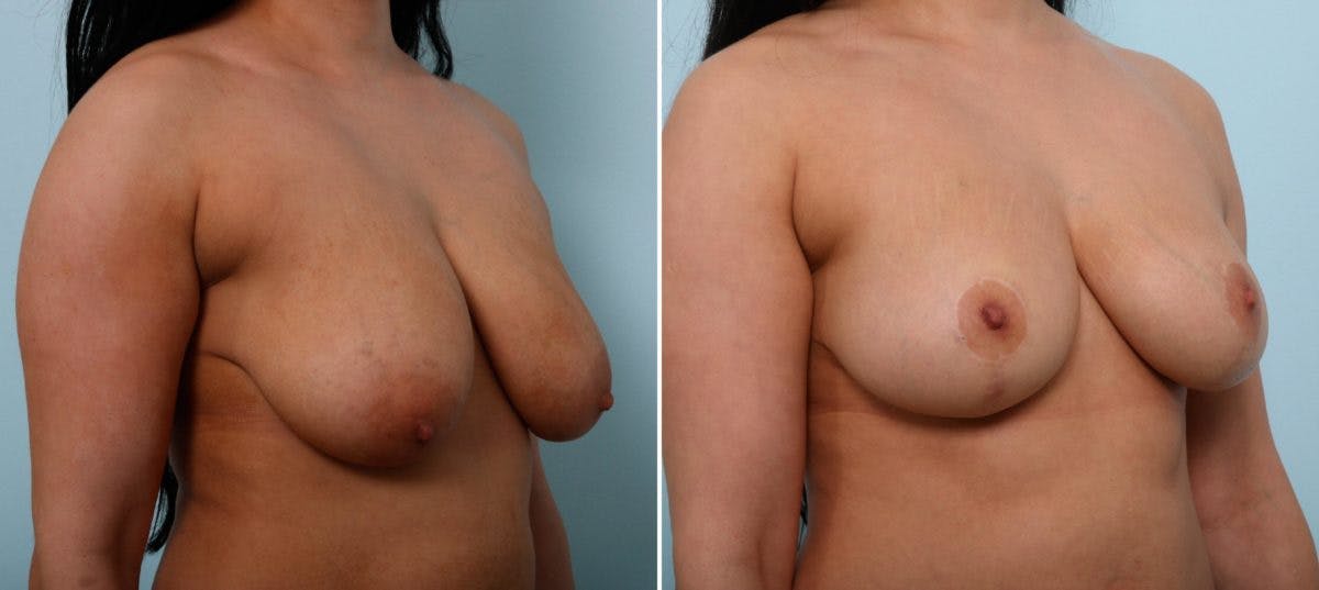 Breast Lift Before & After Photo - Patient 55078848 - Image 2