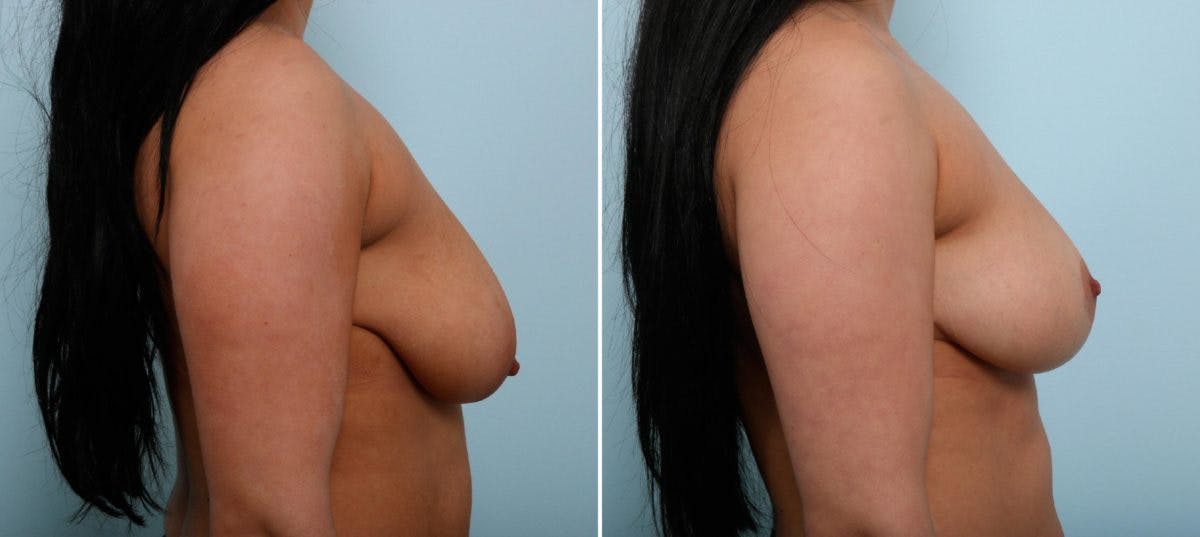 Breast Lift Before & After Photo - Patient 55078848 - Image 3
