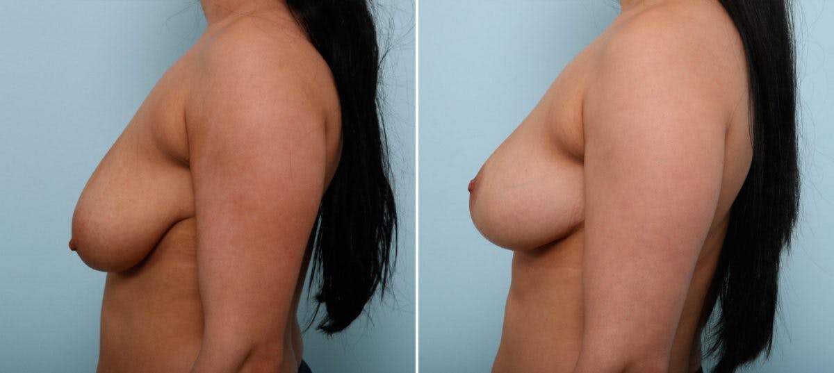 Breast Lift Before & After Photo - Patient 55078848 - Image 5