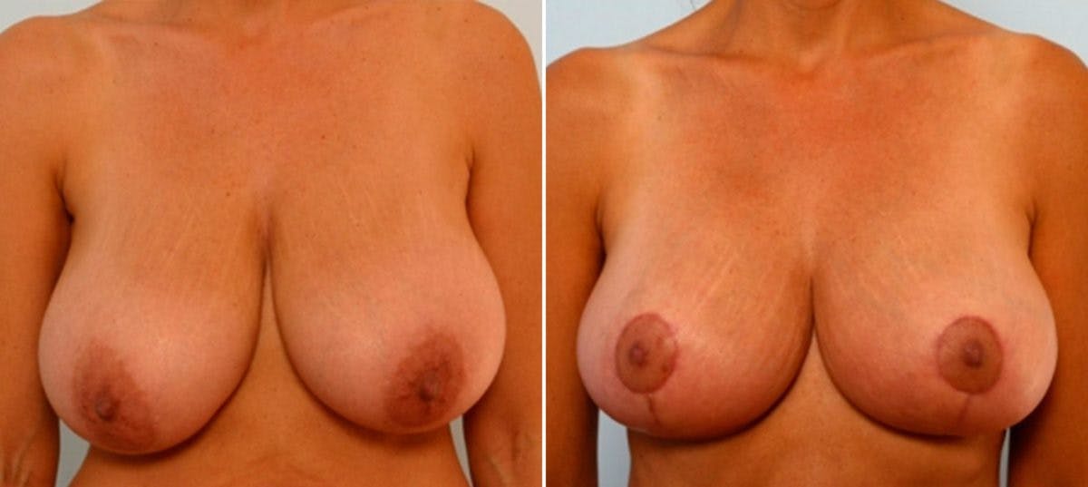 Breast Lift Before & After Photo - Patient 55078849 - Image 1