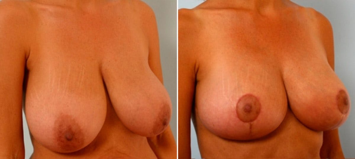 Breast Lift Before & After Photo - Patient 55078849 - Image 2