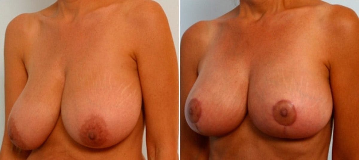 Breast Lift Before & After Gallery - Patient 55078849 - Image 4